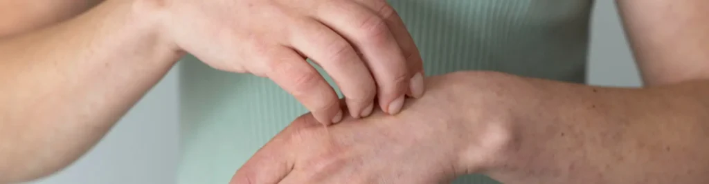 artrite psoriásica