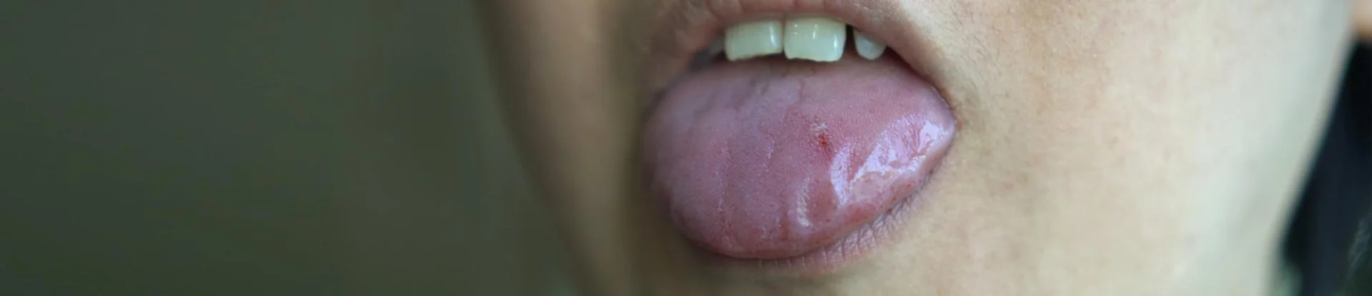 Síndrome de Sjögren: Sintomas, Causas e Diagnóstico